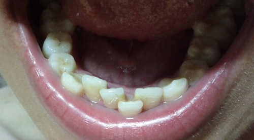 sunxc 2013-07-20 19:49 项目:牙齿矫正 (2)人关注该问题