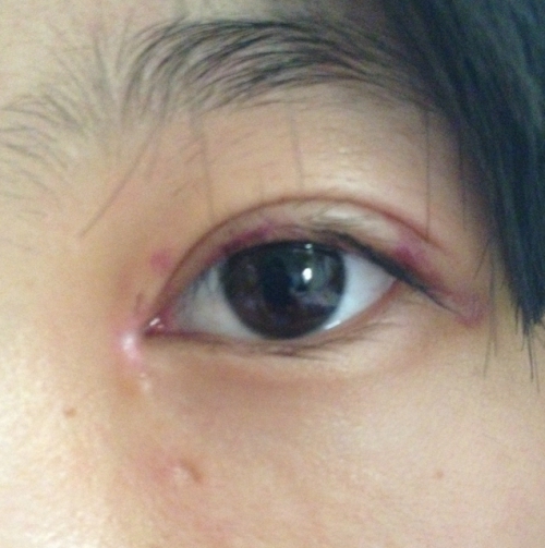 拆线后第一天.眼角部分凸起是增生还是没消肿?